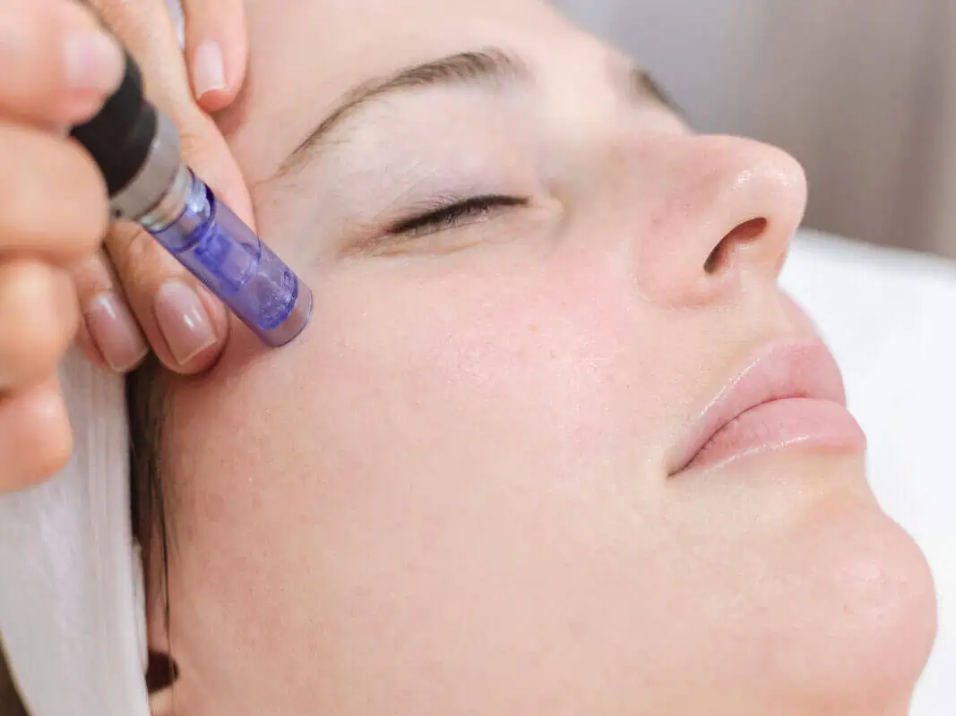 microneedlingbytheskinacademyinpeachtreecity